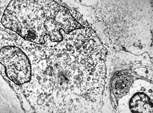 F,55y. | leiomyosarcoma - omentum F,55y. | leiomyosarcoma - omentum